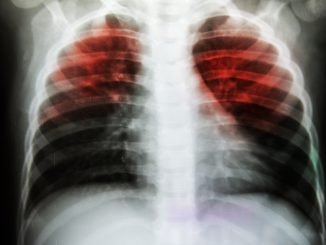 Tuberculosis